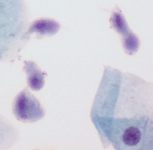 Several Trichomonas organisms with squamous cell (bottom right) for scale; note the pear shape of the protozoan, with a central ovoid nucleus.